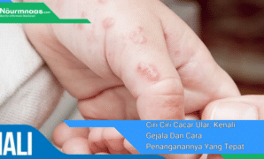 Ciri Ciri Cacar Ular: Kenali Gejala Dan Cara Penanganannya Yang Tepat